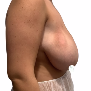 Breast Reduction Before After