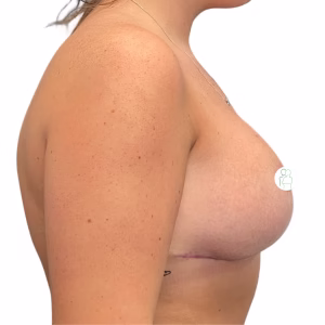 Breast Reduction Before After