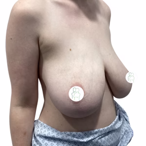 Breast Reduction Before After