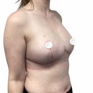 Breast Reduction Before After