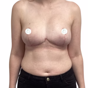 Breast Reduction Ashleigh Patterson Before After
