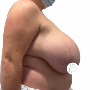 Before breast reduction – right view