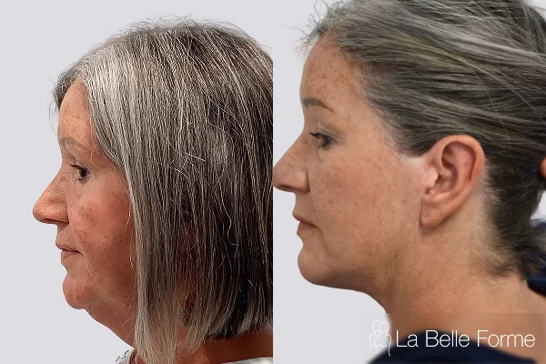 Facelift Before and After 01