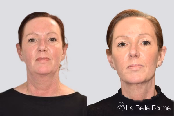 Facelift Before and After 03