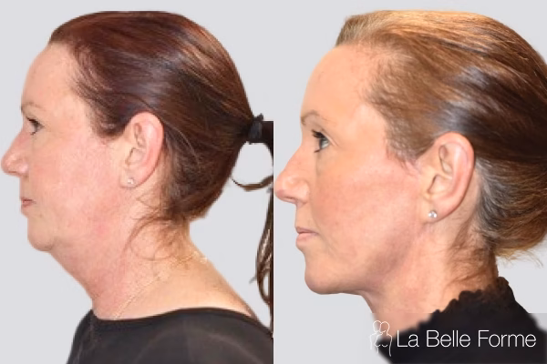 Facelift Before and After 04